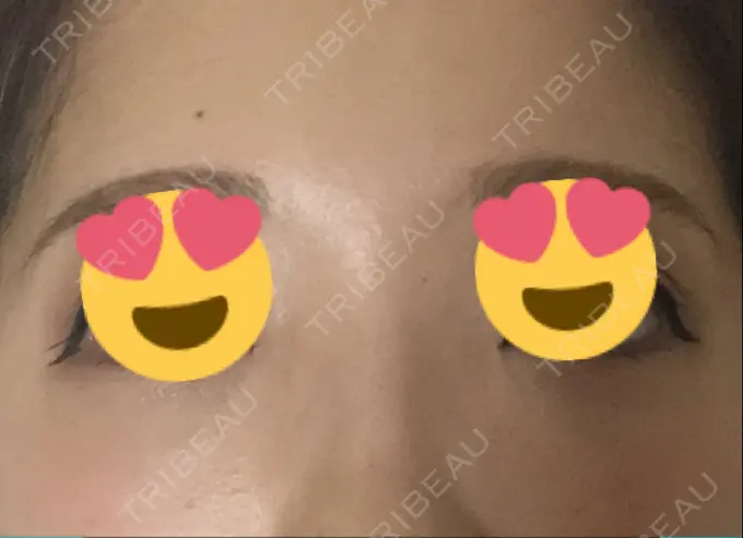 クマ治療 / 下まぶたの脂肪取り / 脂肪注入（肌） / 肌ヒアルロン酸注入（たるみ・シワ改善） 湘南美容クリニック 八王子院 AFTER メイン用