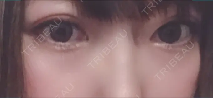 二重埋没 共立美容外科 大宮院 DAY 11 メイン用