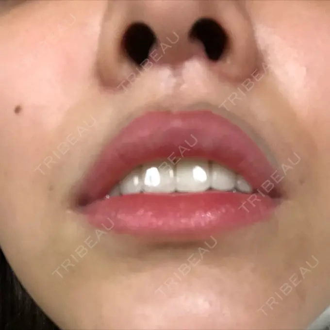 人中短縮 グリム整形外科 DAY 30 メイン用