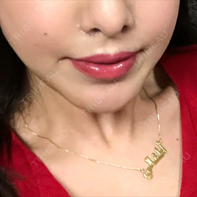 人中短縮 グリム整形外科 DAY 29 メイン用