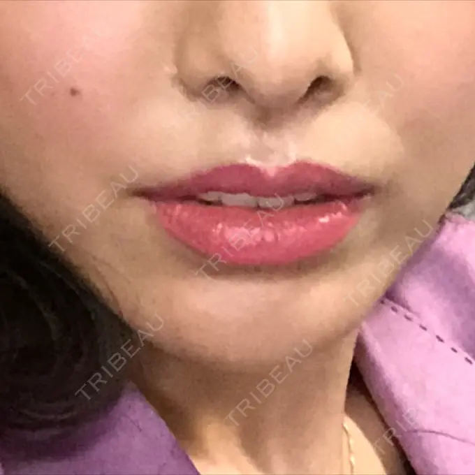 人中短縮 グリム整形外科 DAY 31 メイン用