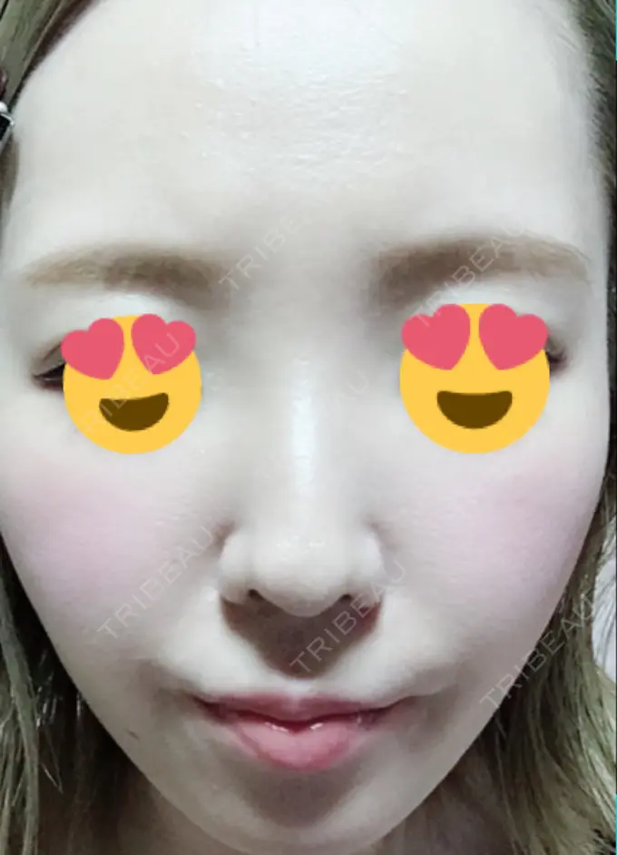 その他（肌） / 美肌レーザー みやた形成外科・皮ふクリニック DAY 15 メイン用