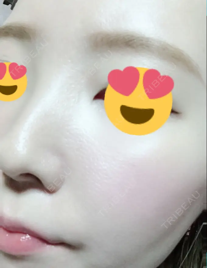 その他（肌） / 美肌レーザー みやた形成外科・皮ふクリニック DAY 15 メイン用