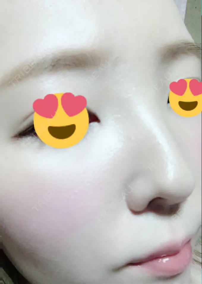 その他（肌） / 美肌レーザー みやた形成外科・皮ふクリニック DAY 15 メイン用