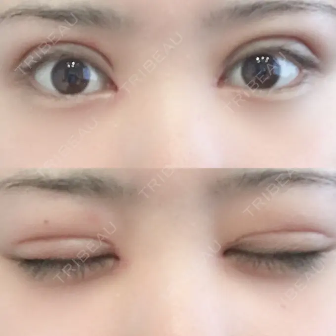 二重切開 / 目頭切開 城本クリニック 豊橋院 DAY 19 メイン用