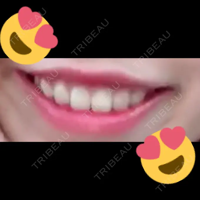 ガミースマイル手術 有楽町美容外科クリニック AFTER メイン用