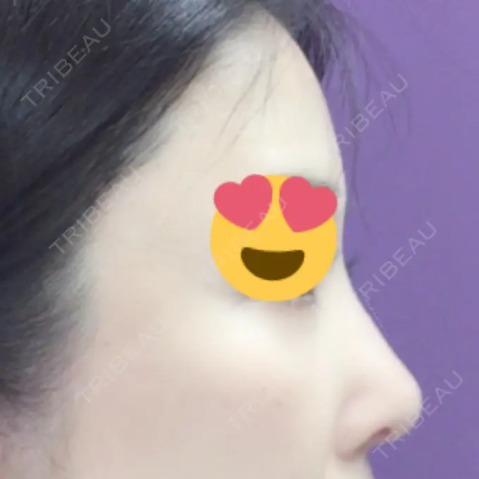 隆鼻術 / 鼻尖形成（切開） / 鼻中隔延長（切開） / 骨切幅寄せ / ワシ鼻修正・ハンプ切除 / ヒアルロン酸溶解 ミナ美容外科 DAY 69 メイン用