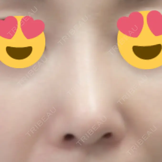 隆鼻術 / 鼻尖形成（切開） / 鼻中隔延長（切開） / 骨切幅寄せ / ワシ鼻修正・ハンプ切除 / ヒアルロン酸溶解 ミナ美容外科 DAY 69 メイン用