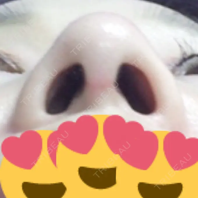 隆鼻術 / 鼻尖形成（切開） / 鼻中隔延長（切開） / 骨切幅寄せ / ワシ鼻修正・ハンプ切除 / ヒアルロン酸溶解 ミナ美容外科 DAY 69 メイン用