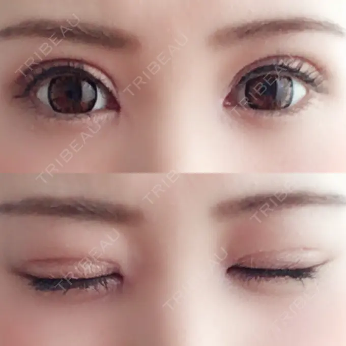 二重切開 / 目頭切開 城本クリニック 豊橋院 DAY 20 メイン用