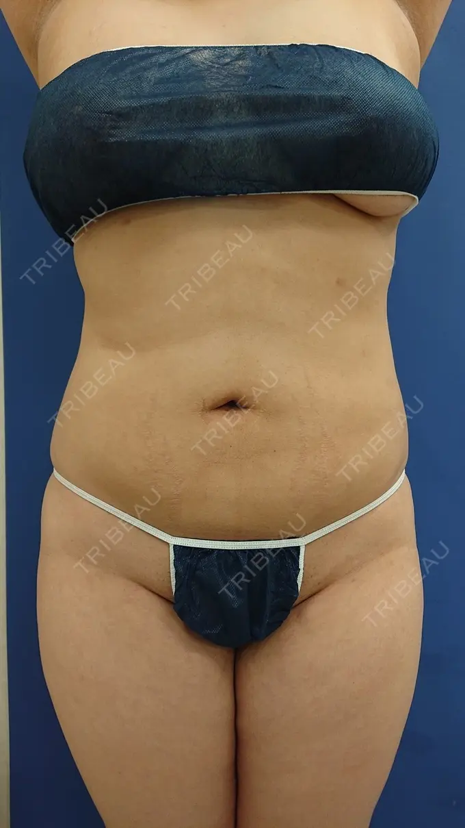 脂肪吸引（お腹） 城本クリニック 岡山院 AFTER メイン用