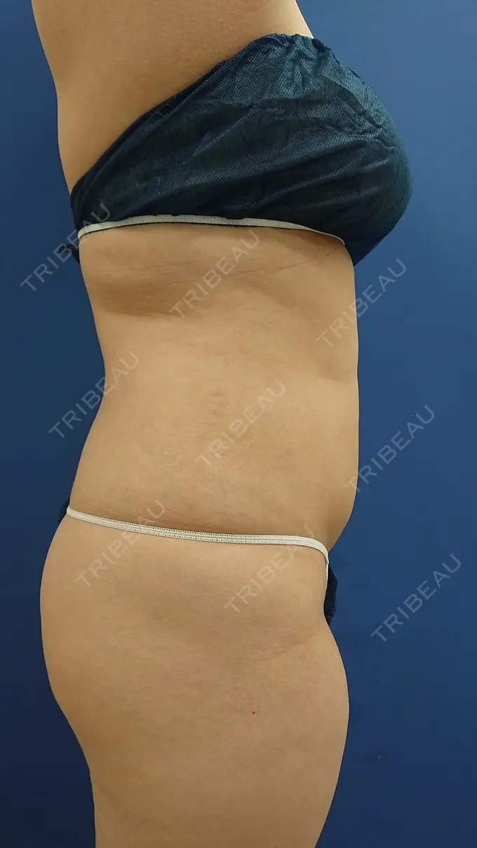 脂肪吸引（お腹） 城本クリニック 岡山院 DAY 30 メイン用