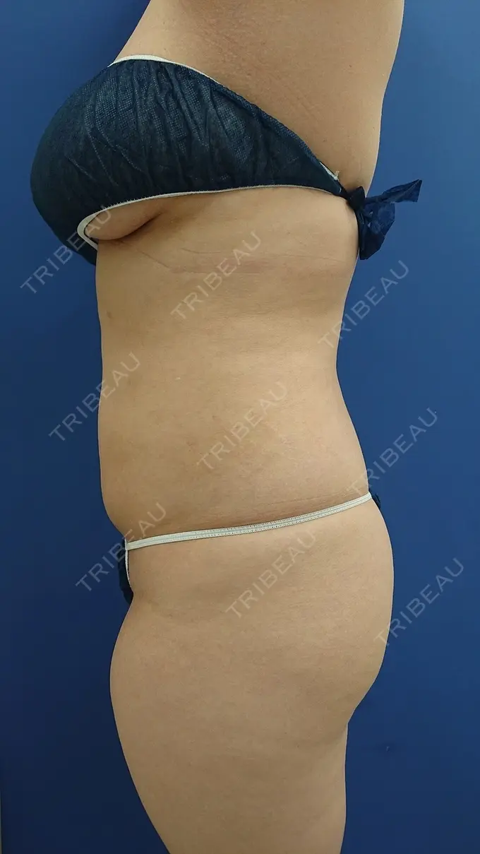 脂肪吸引（お腹） 城本クリニック 岡山院 DAY 30 メイン用