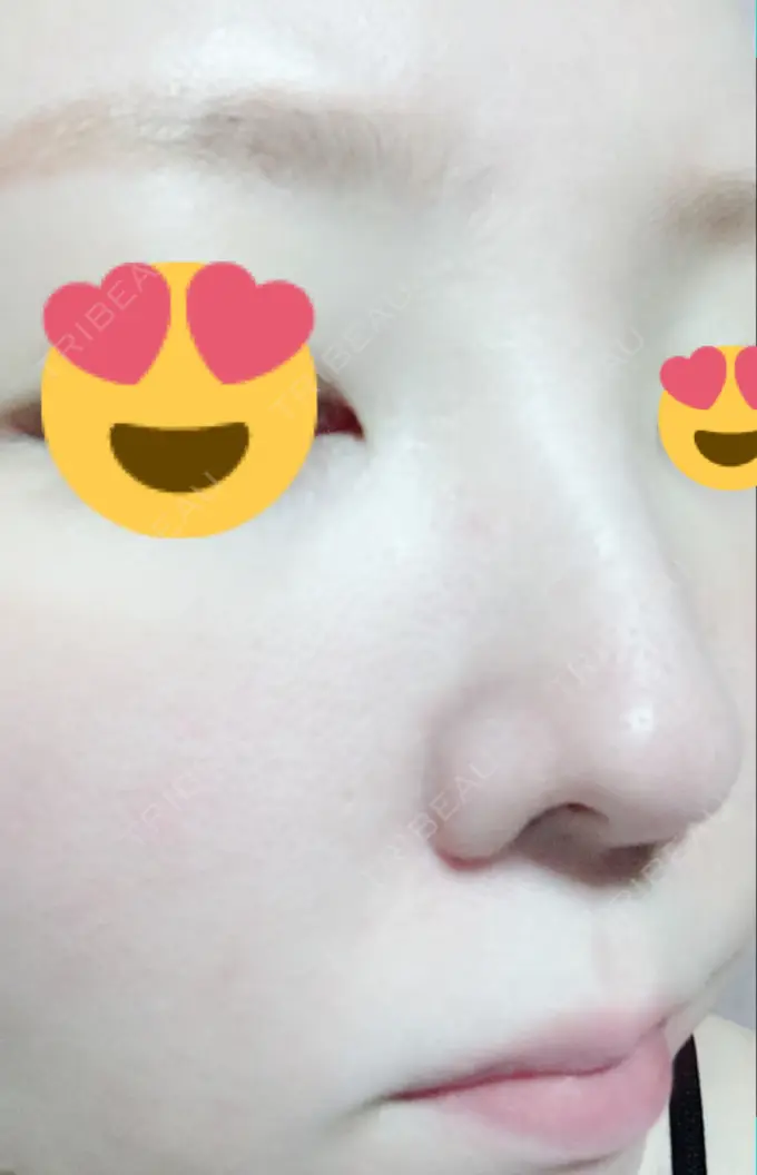 その他（肌） / 美肌レーザー みやた形成外科・皮ふクリニック DAY 17 メイン用