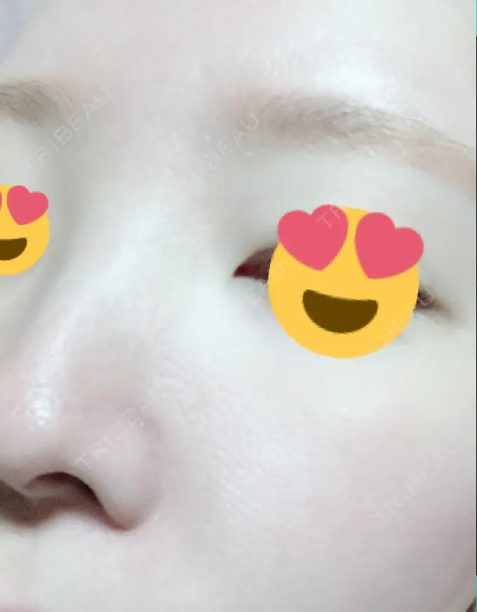 その他（肌） / 美肌レーザー みやた形成外科・皮ふクリニック DAY 17 メイン用