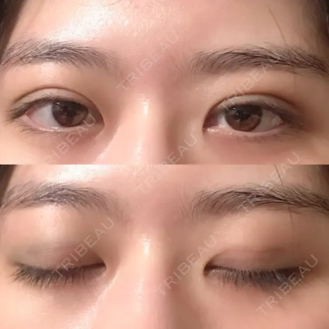 二重埋没 / ボトックス（エラ・小顔） 湘南美容クリニック 二子玉川院 DAY 0 メイン用