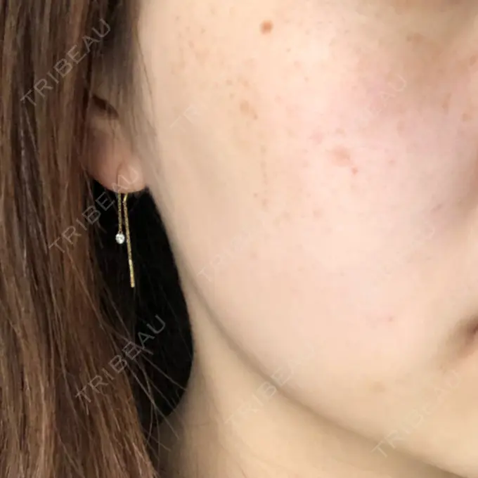 シミ取りレーザー 野口皮膚科医院 AFTER メイン用