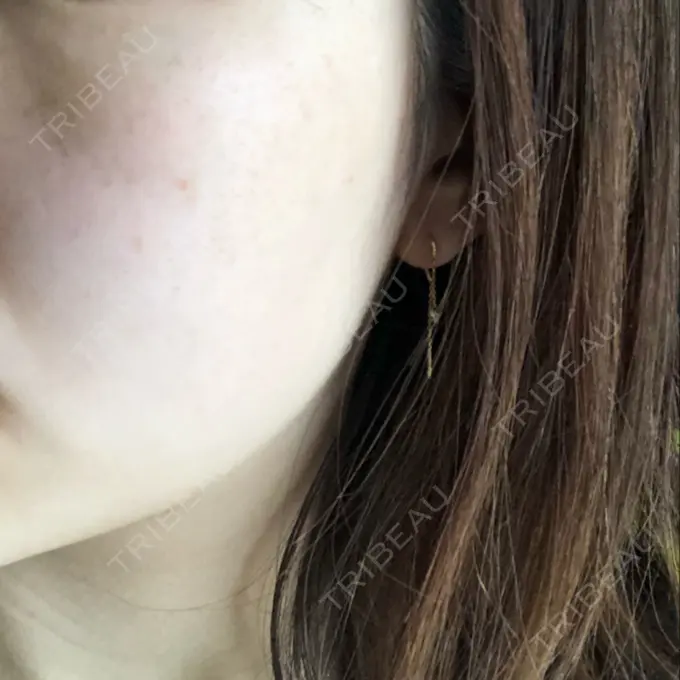 シミ取りレーザー 野口皮膚科医院 DAY 31 メイン用