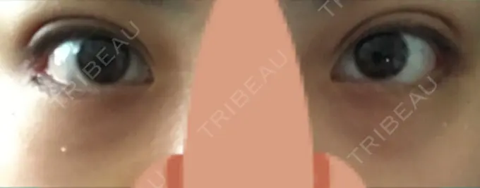 目尻切開 / 自然癒着法 FROM B整形外科 (旧バウム整形外科) DAY 26 メイン用