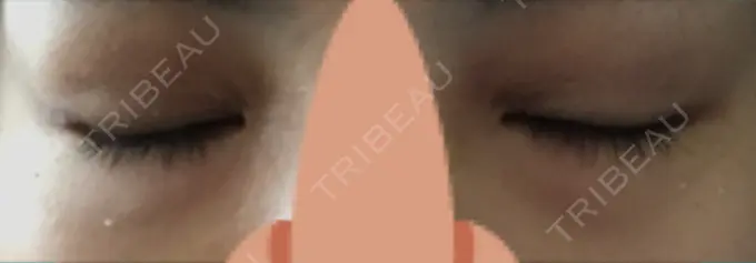 目尻切開 / 自然癒着法 FROM B整形外科 (旧バウム整形外科) DAY 26 メイン用