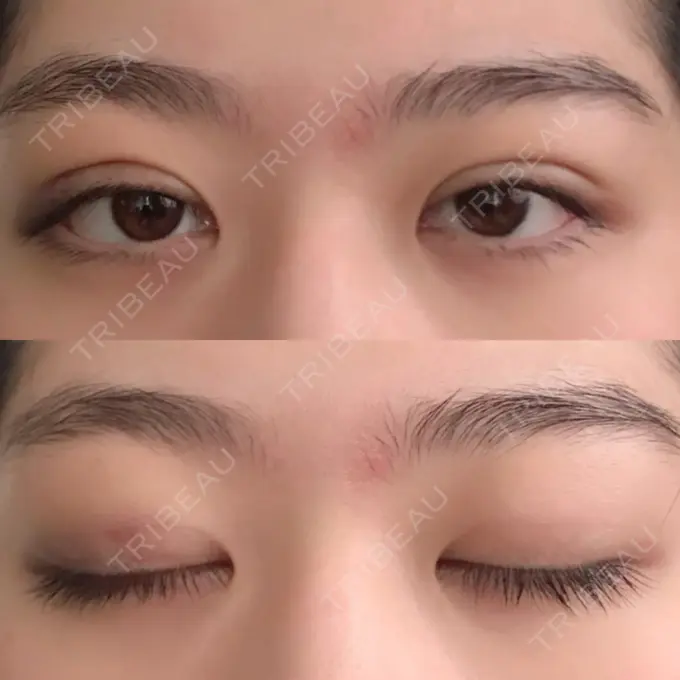 二重埋没 / ボトックス（エラ・小顔） 湘南美容クリニック 二子玉川院 DAY 1 メイン用