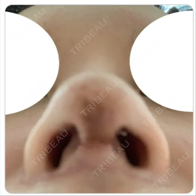 鼻尖形成（切開） / 鼻中隔延長（切開） / 軟骨移植 / 鼻尖縮小 エートップ美容整形外科 DAY 33 メイン用
