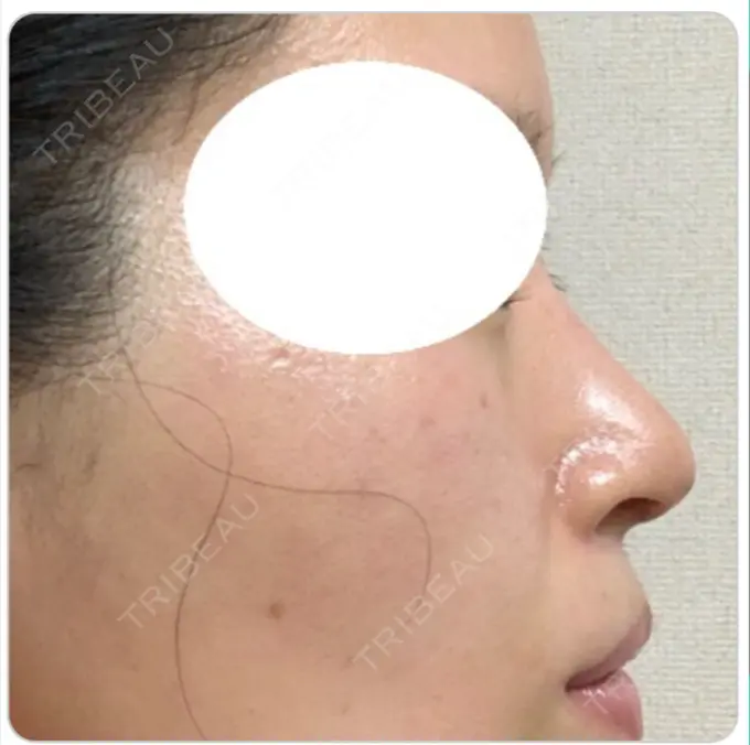 鼻尖形成（切開） / 鼻中隔延長（切開） / 軟骨移植 / 鼻尖縮小 エートップ美容整形外科 DAY 33 メイン用