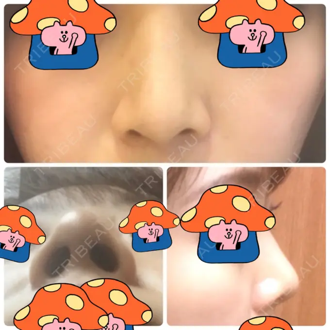 鼻尖形成（切開） / 軟骨移植 白山クリニック 大分 DAY 31 メイン用