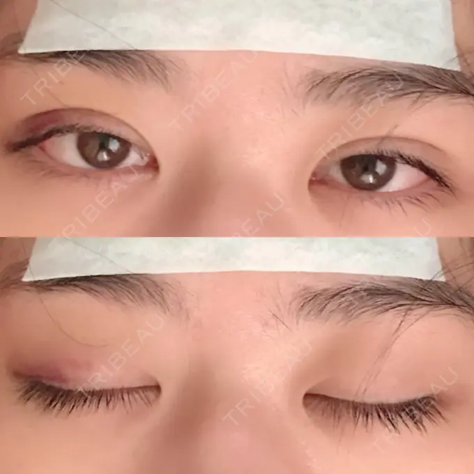 二重埋没 / ボトックス（エラ・小顔） 湘南美容クリニック 二子玉川院 DAY 2 メイン用