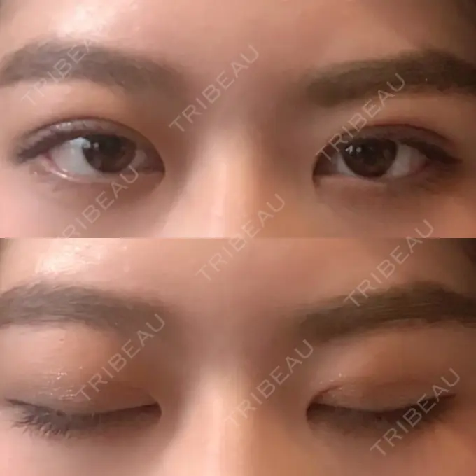 二重埋没 / ボトックス（エラ・小顔） 湘南美容クリニック 二子玉川院 DAY 2 メイン用