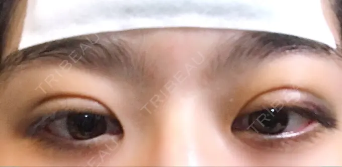 二重埋没 / ボトックス（エラ・小顔） 湘南美容クリニック 二子玉川院 DAY 2 メイン用