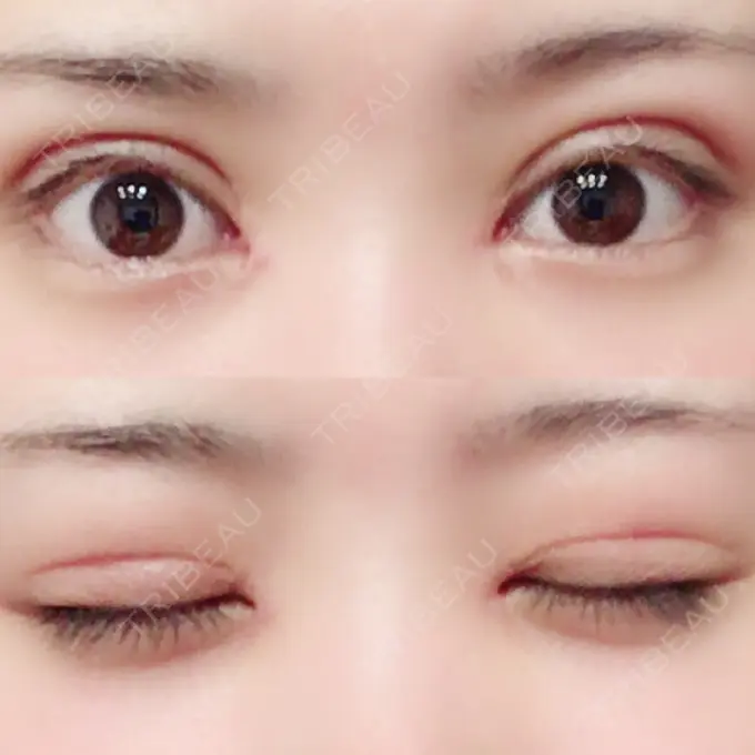 二重切開 / 目頭切開 城本クリニック 豊橋院 DAY 23 メイン用