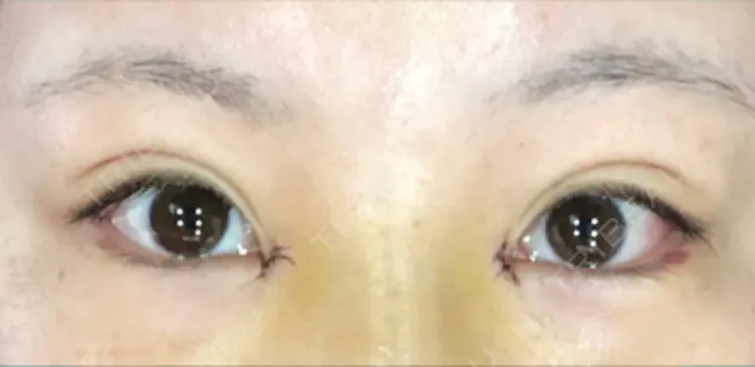 目頭切開 / バッカルファット除去 / 目尻切開 / 眉間プロテーゼ 湘南美容クリニック 大宮院 DAY 5 メイン用