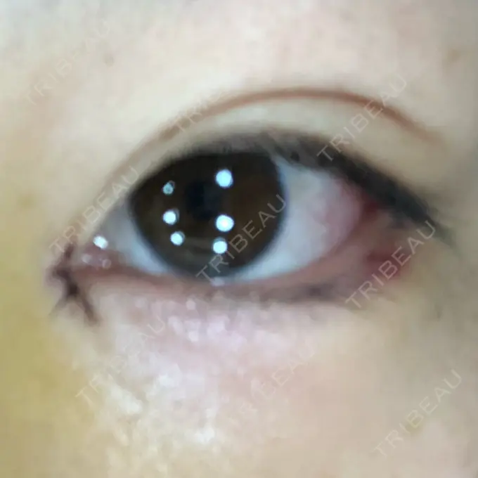 目頭切開 / バッカルファット除去 / 目尻切開 / 眉間プロテーゼ 湘南美容クリニック 大宮院 DAY 5 メイン用