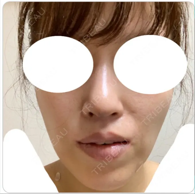 鼻尖形成（切開） / 鼻中隔延長（切開） / 軟骨移植 / 鼻尖縮小 エートップ美容整形外科 DAY 38 メイン用