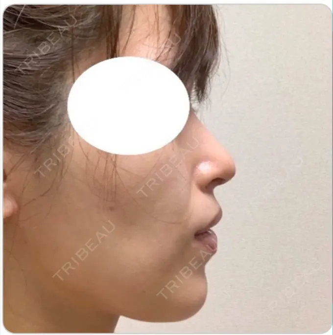 鼻尖形成（切開） / 鼻中隔延長（切開） / 軟骨移植 / 鼻尖縮小 エートップ美容整形外科 DAY 38 メイン用