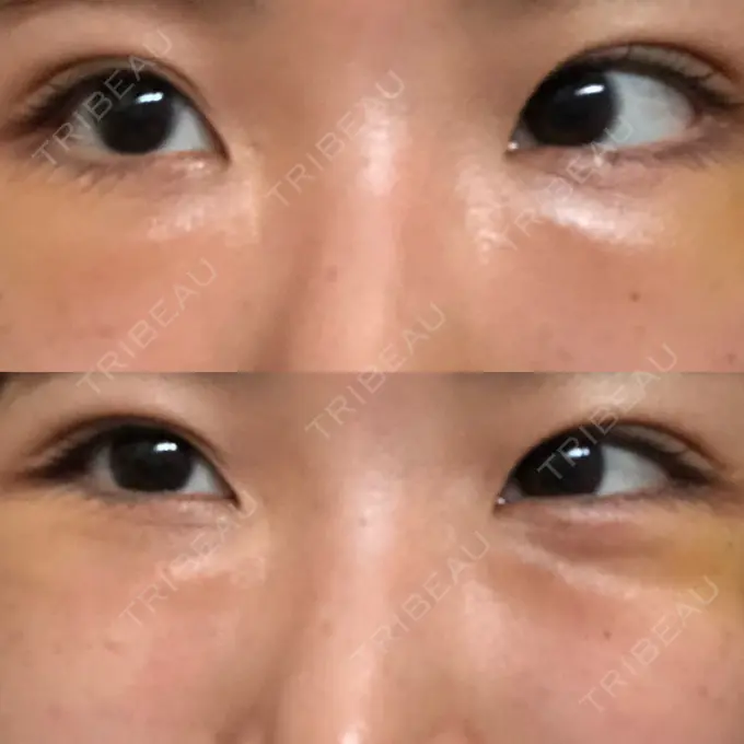 クマ治療 韓国ST美容整形外科 DAY 8 メイン用