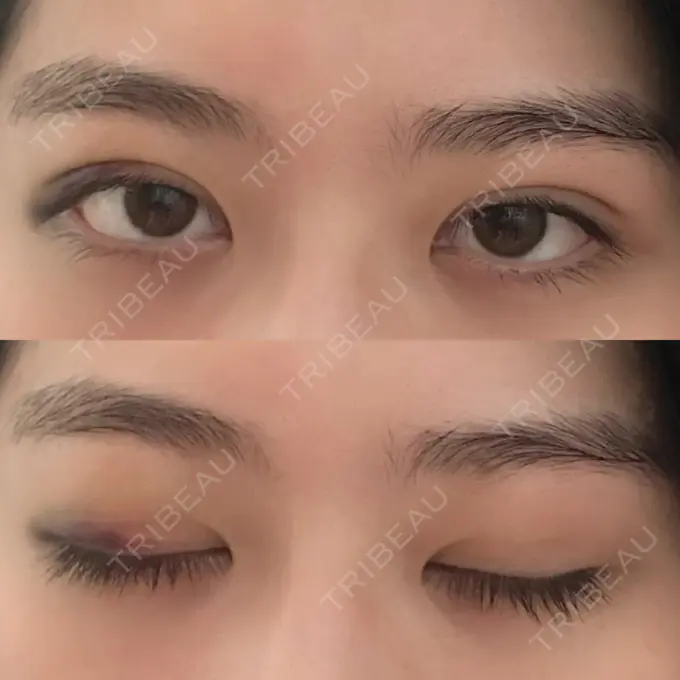 二重埋没 / ボトックス（エラ・小顔） 湘南美容クリニック 二子玉川院 DAY 4 メイン用