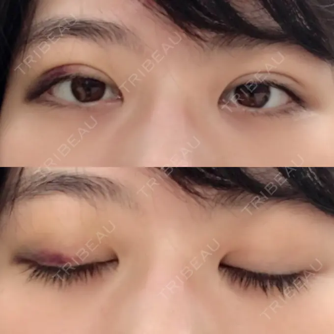 二重埋没 / ボトックス（エラ・小顔） 湘南美容クリニック 二子玉川院 DAY 6 メイン用