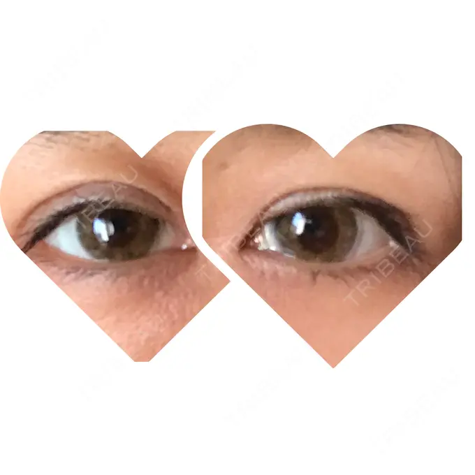 眼瞼下垂（切開） ブリスクリニック形成外科・美容外科・美容皮膚科 福岡 AFTER メイン用