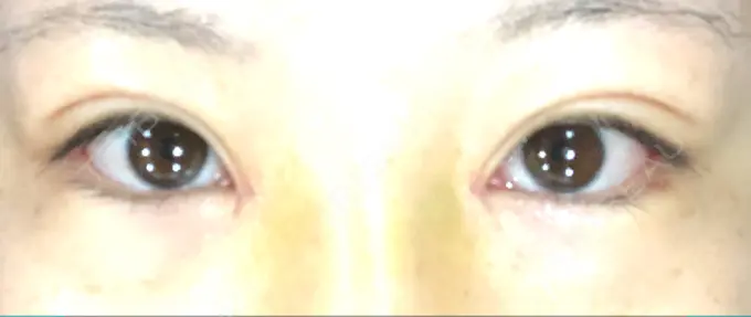 目頭切開 / バッカルファット除去 / 目尻切開 / 眉間プロテーゼ 湘南美容クリニック 大宮院 DAY 7 メイン用