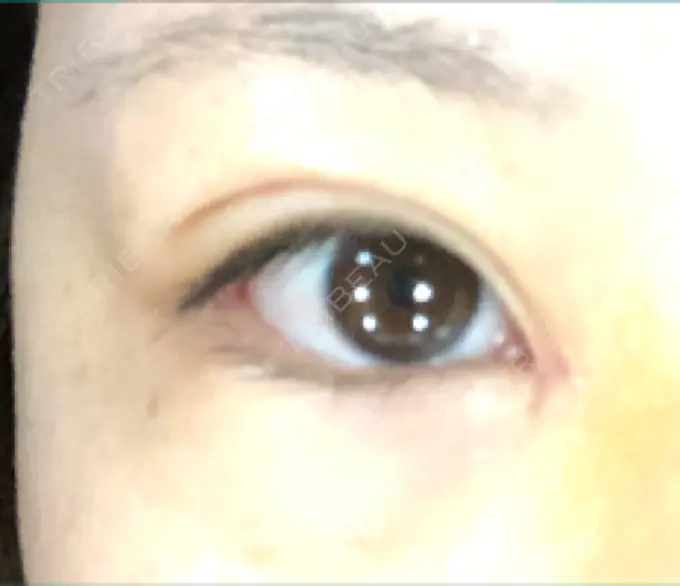 目頭切開 / バッカルファット除去 / 目尻切開 / 眉間プロテーゼ 湘南美容クリニック 大宮院 DAY 7 メイン用