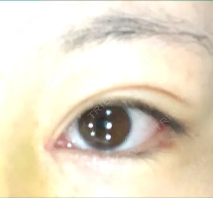 目頭切開 / バッカルファット除去 / 目尻切開 / 眉間プロテーゼ 湘南美容クリニック 大宮院 DAY 7 メイン用