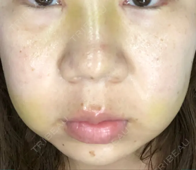 目頭切開 / バッカルファット除去 / 目尻切開 / 眉間プロテーゼ 湘南美容クリニック 大宮院 AFTER メイン用