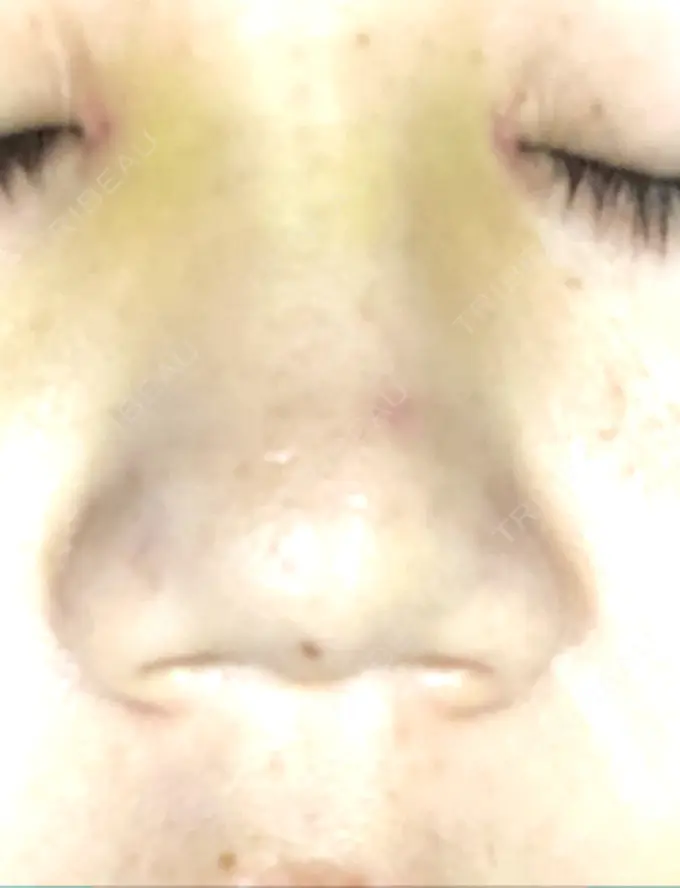 目頭切開 / バッカルファット除去 / 目尻切開 / 眉間プロテーゼ 湘南美容クリニック 大宮院 DAY 7 メイン用