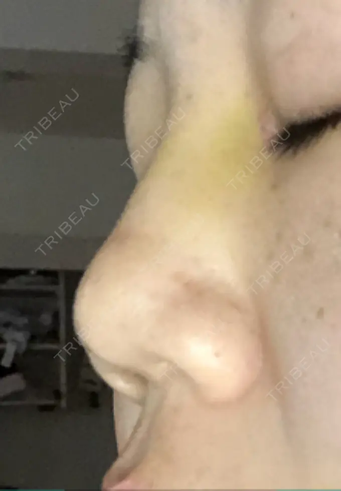 目頭切開 / バッカルファット除去 / 目尻切開 / 眉間プロテーゼ 湘南美容クリニック 大宮院 DAY 7 メイン用