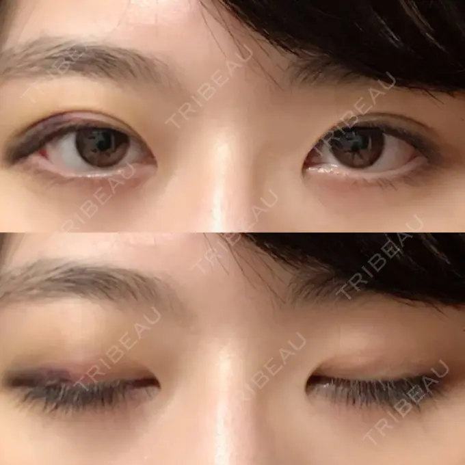 二重埋没 / ボトックス（エラ・小顔） 湘南美容クリニック 二子玉川院 AFTER メイン用