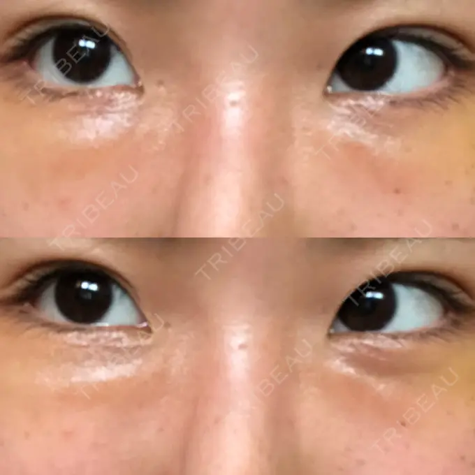 クマ治療 韓国ST美容整形外科 DAY 10 メイン用