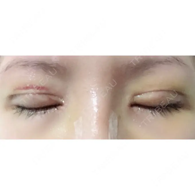 二重切開 / 目頭切開 / 上まぶたの脂肪取り / 蒙古ひだ形成 FROM B整形外科 (旧バウム整形外科) DAY 7 メイン用