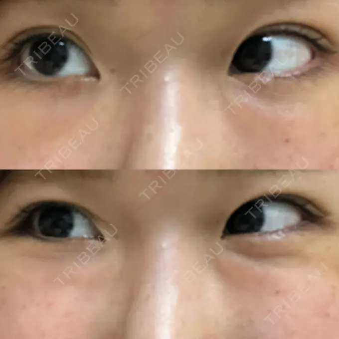 クマ治療 韓国ST美容整形外科 DAY 12 メイン用